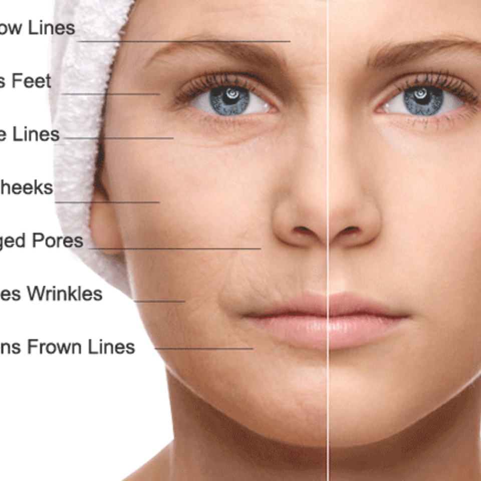 What does microneedling do