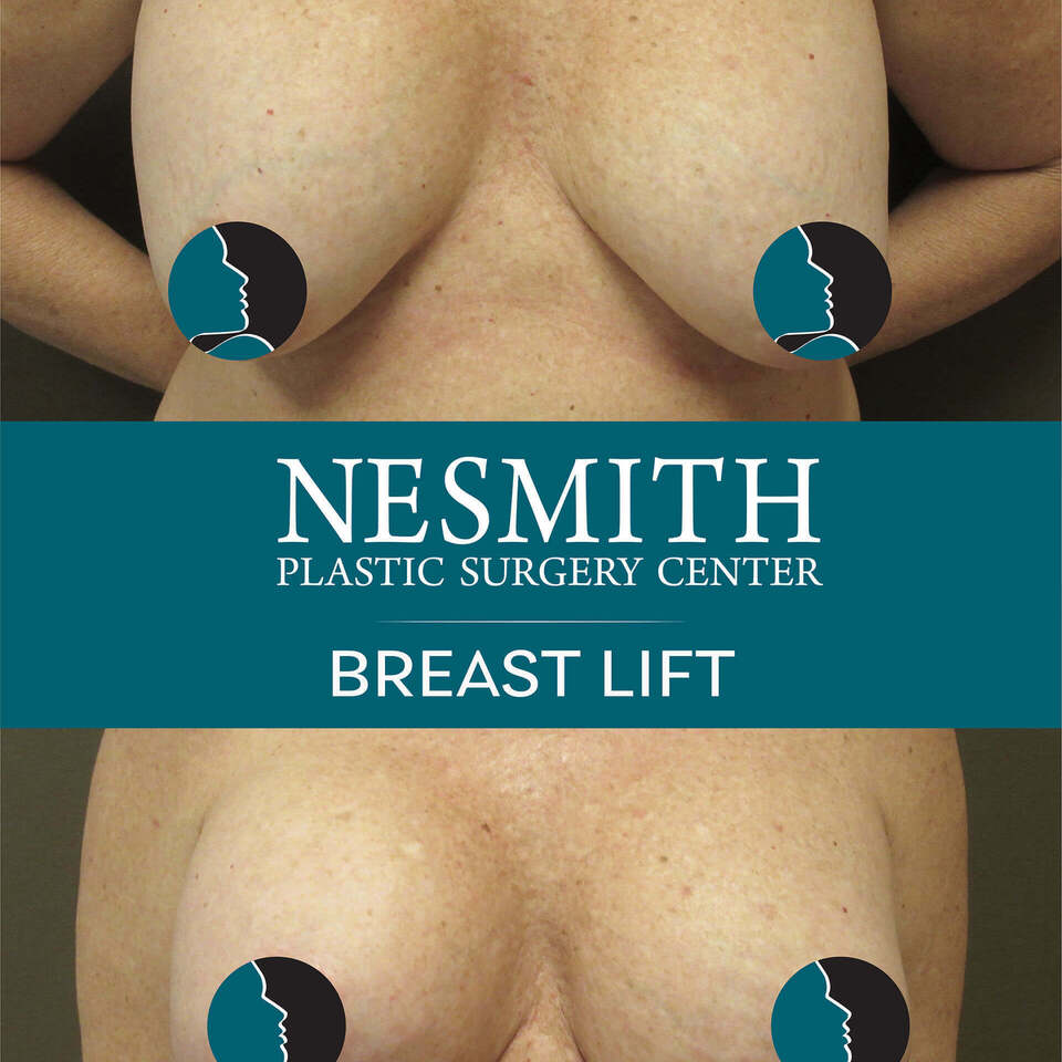 Nps social breasts lift 04