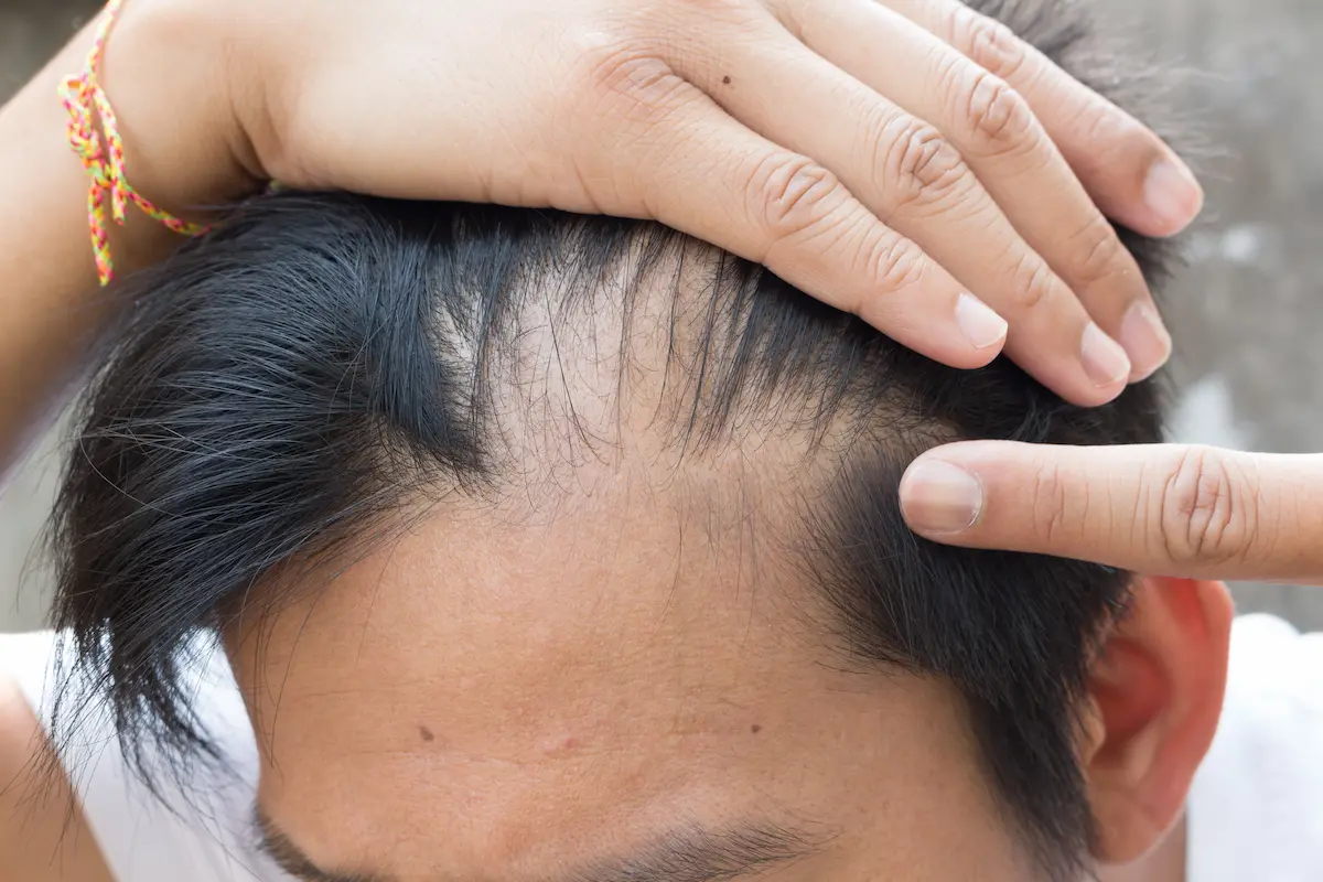 A man examining hair loss on a comb representing the concern and vulnerability that patients experiencing hair loss carry when searching for a qualified trichologist or hair loss specialist