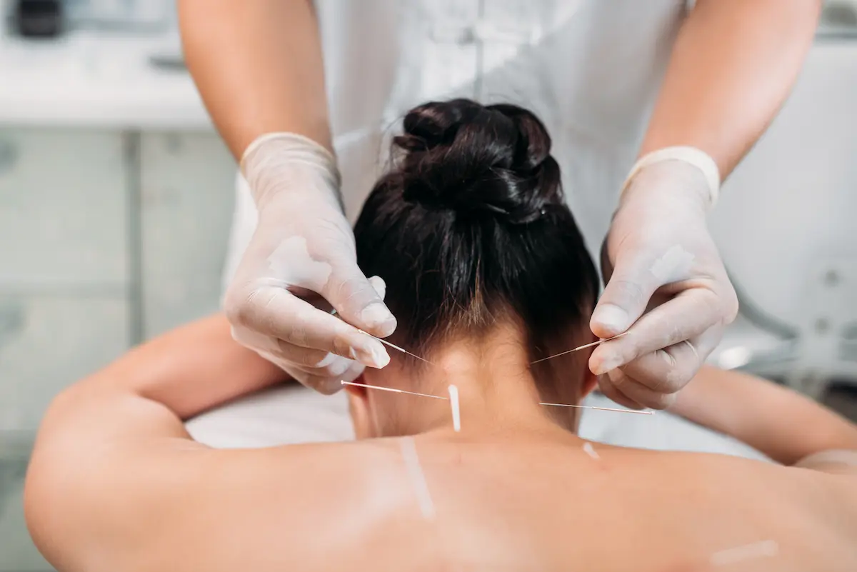A licensed acupuncturist carefully placing acupuncture needles on a patient's back during a treatment session representing the skilled, gentle, and therapeutic acupuncture care that a professional acupuncture clinic provides for pain management, wellness, and holistic health